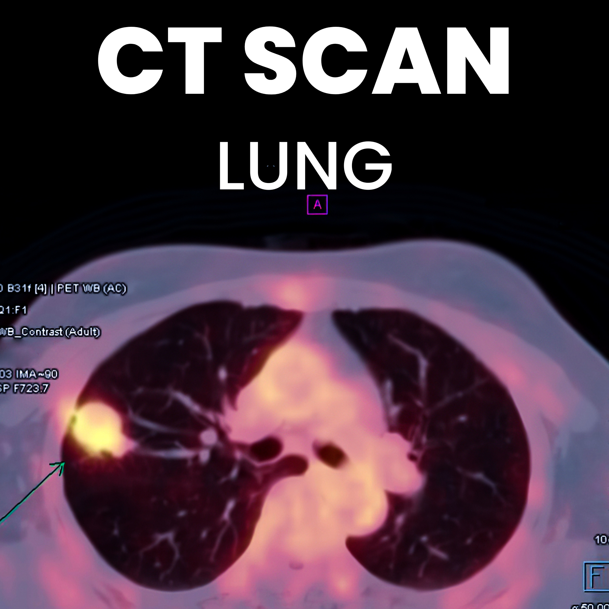 CT Scan Lung